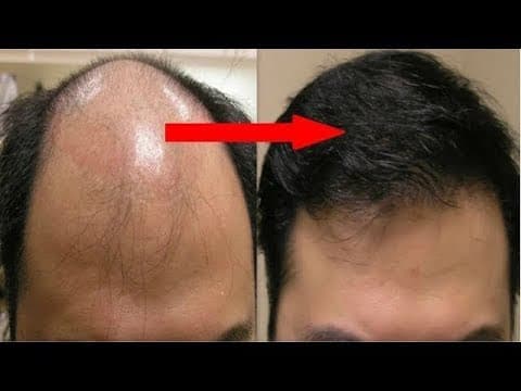 आपके सिर के बाल दोबारा आ सकते हैं ,जानिए कैसे....