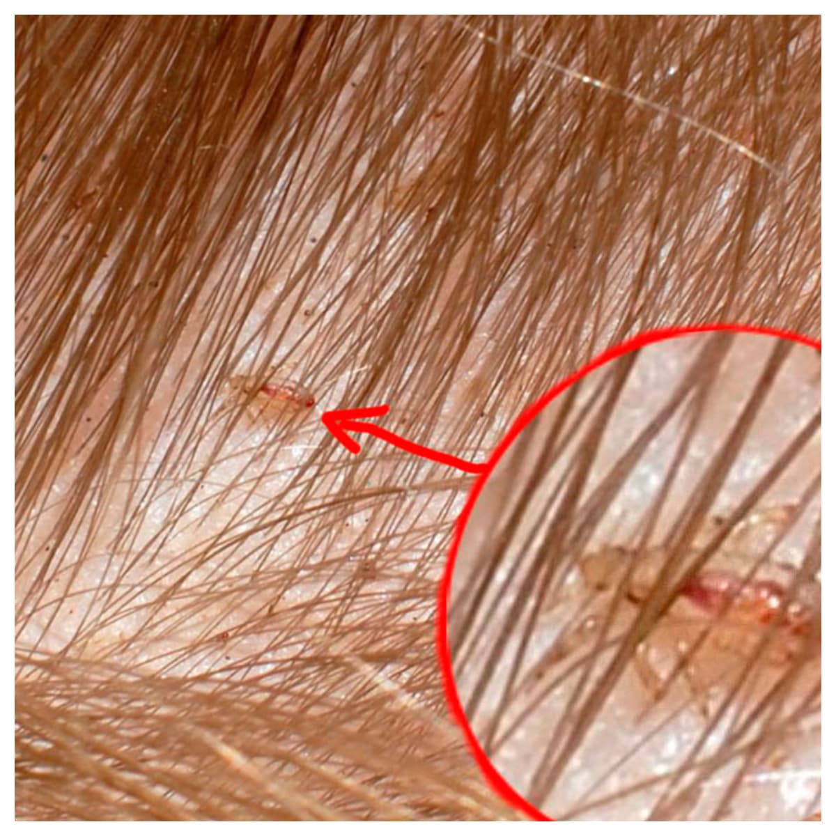 सिर की जूं और लीक हो जायेंगे बिलकुल साफ